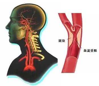 主动脉硬化能活十年吗 主动脉硬化