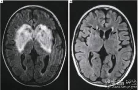 脑炎后遗症能治好吗 脑炎后遗症有哪些 脑炎后遗症能治好吗 及早治疗脑炎治愈效果好