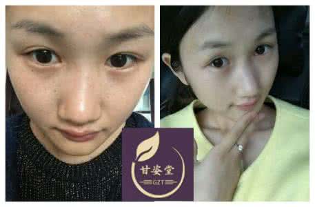 脸上长大块黑斑怎么办 脸上长大块黑斑怎么办?