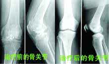 退行性骨关节病特效药 骨关节病特效方