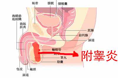 治疗附睾炎需要多少钱 治疗附睾炎需要多少钱 附睾炎怎么治疗？治疗附睾炎需要多久