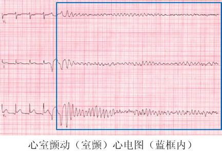 室颤如何抢救 如何预防室颤？