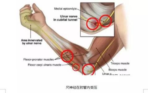 针灸后手麻 尺神经干针法治手麻手瘫效果快