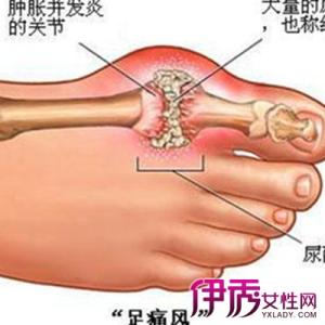 尿酸高能吃海参吗 尿酸高痛风能吃海参吗?