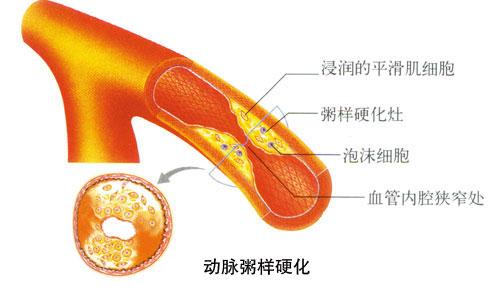 高血脂 认识高血脂