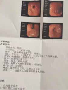 胃出血的症状有哪些 胃出血症状 胃出血有哪些症状