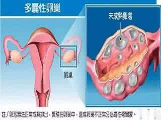 多囊卵巢怎么治疗最好 多囊卵巢 怎么治疗多囊卵巢