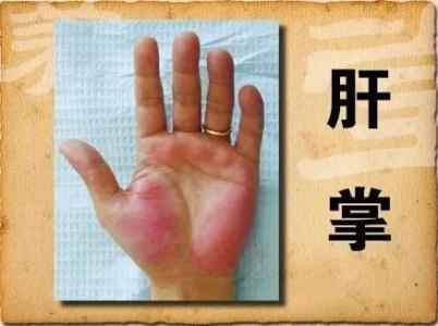 郑州乙肝医院好不好 想知道你的肝好不好？看看你的手就知道！