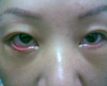 怎么消除眼袋和眼纹 4招消除大眼袋眼纹，让你瞬间年轻10岁！