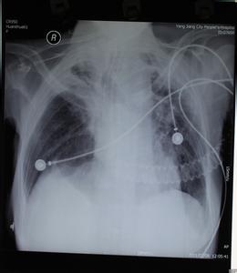 新生儿重症肺炎治愈率 重症肺炎是怎么引起的 新生儿重症肺炎是怎么回事