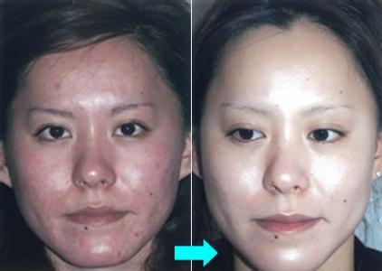 哪种去斑方法效果好 六种方法去斑