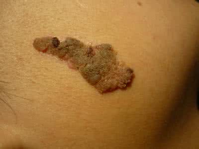 疣状痣最佳治疗方法 疣状痣最佳治疗方法 别再为你的“痣”“疣”“斑”花冤枉钱了