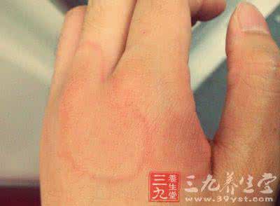 荨麻疹吃什么好得快 荨麻疹是怎么回事 荨麻疹怎么治疗好得快