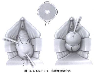 宫颈缝合术 宫颈缝合术 宫颈缝合术运用在哪些方面