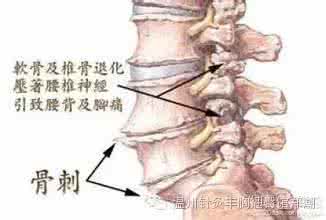 腰椎骨质增生手术治疗 什么是骨质增生？什么样的骨质增生才需要手术治疗？