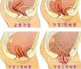 子宫脱垂的治疗 子宫脱垂的治疗 子宫脱垂的治疗 遇到子宫脱垂该怎么办