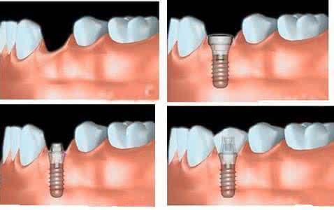 种植牙手术后发烧 种植牙后发烧怎么回事？