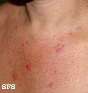 日光性皮炎临床表现 日光性皮炎临床表现 多形性日光疹 多形性日光疹的临床表现