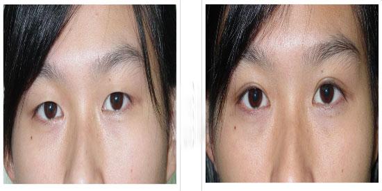 三角眼矫正术 三角眼矫正术 中老年三角眼矫正