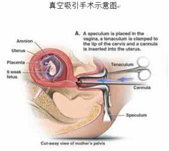 人工流产指南 人工流产指南 人工流产全案解析指南