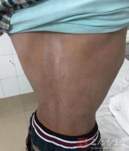 湖南汞中毒事件 湖南多名小学生汞中毒 用盒子装水银玩