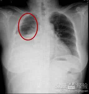 结核性胸膜炎症状 结核性胸膜炎症状有哪些