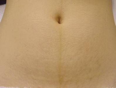 严重孕妇妊娠纹图片 哪些孕妈妈易长妊娠纹