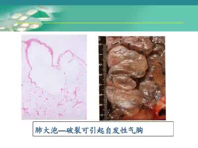 肺大泡破裂有什么症状 肺大泡破裂有什么症状 做好护理很重要