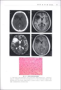 脑膜瘤病理分型 脑膜肿瘤的分型及病理表现（含视频讲座）