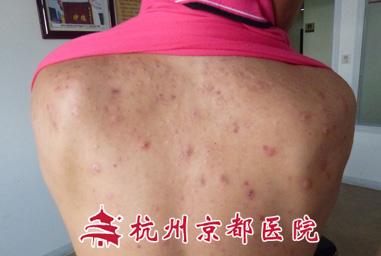 脸上长痘痘调理秘诀 背上长痘痘四大秘诀料理它