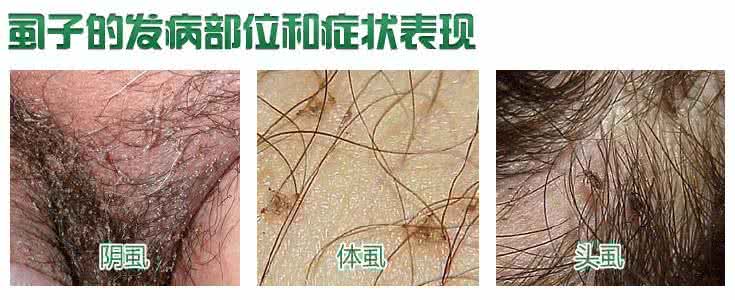 阴虱最好的治疗方法 阴虱怎么治疗 这些方法能治阴虱