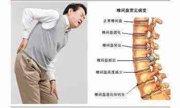 腰椎间盘突出症状表现 腰椎间盘突出的症状表现