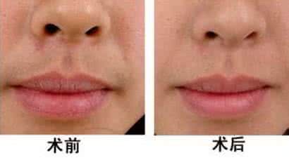 唇部永久脱毛 唇部脱毛 唇部永久脱毛