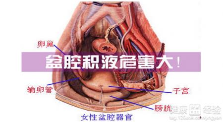 男性盆腔积液是癌症吗 盆腔积液会变成癌吗？