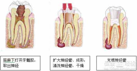 牙髓炎根管治疗 牙髓炎根管治疗 其适应症是什么