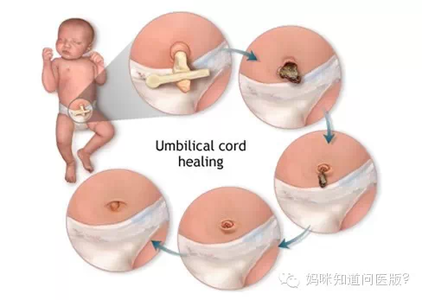 新生儿脐带怎么护理 新生儿脐带怎么护理 新生儿需注意脐带护理