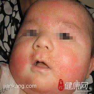 婴儿湿疹用什么药膏 婴儿湿疹用什么药膏 婴儿湿疹原因、治疗及药膏的使用
