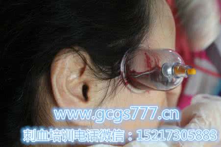 王氏刺血疗法 王氏刺血疗法穴位经验总结