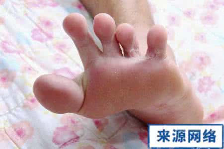 脚气水泡型偏方秘方 水泡脚气怎么根治 了解病因对症治疗才有效