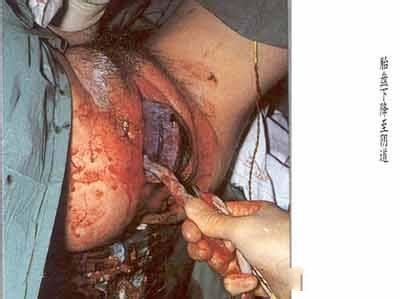 中国女子顺产全过程 顺产过程