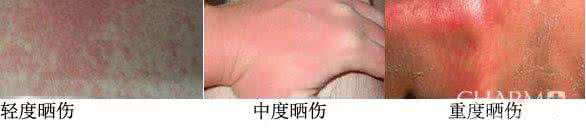 皮肤晒伤发红怎么办 皮肤晒伤发红疼痛 皮肤晒伤了 没及时处理 疼痛 该怎么办