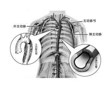 主动脉夹层 高血压患者贪杯 引爆体内炸弹“主动脉夹层”