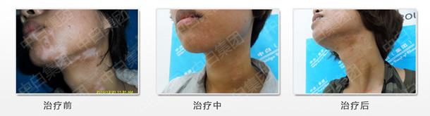 白灵片效果怎么样 白灵片治疗白癜风的效果如何？