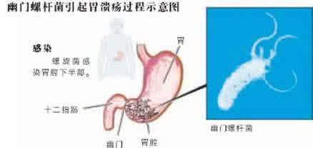 胃溃疡的危害 胃溃疡危害 胃溃疡的危害有哪些