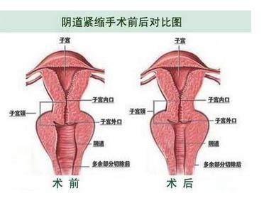 手术缩阴有什么危害吗 女性通过手术缩阴的危害有哪些