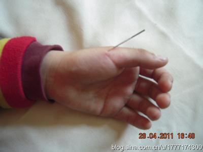 急性腰扭伤的针灸治疗 针灸治疗扭伤要放血吗 中医放血治疗腰扭伤