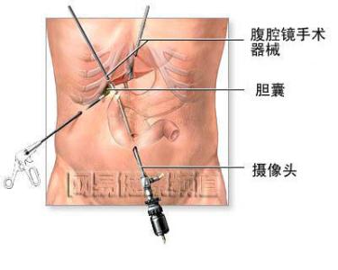 胆囊息肉一定要切除吗 胆囊息肉一定要切吗?