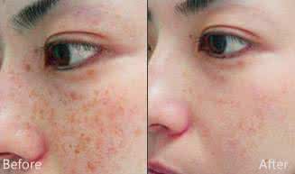 激光祛斑整形医院 e 光祛斑后斑点更深了 整形激光祛斑 斑点暗沉不逗留