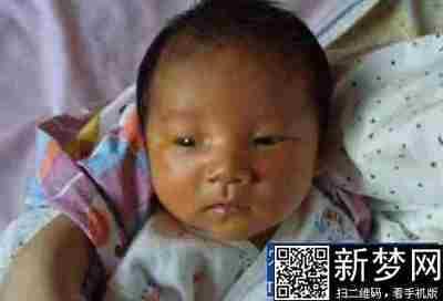 早产儿黄疸怎么办 早产儿黄疸不退怎么办