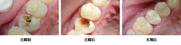孕妇可以补牙窟窿吗 孕妇可以补牙吗